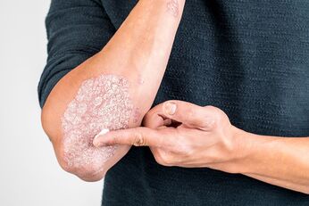 Apply the cream to areas of skin damaged by psoriasis