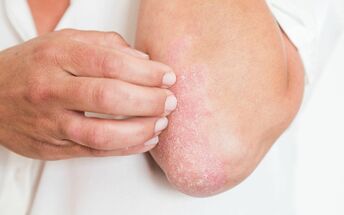 Psoriasis is accompanied by persistent itching