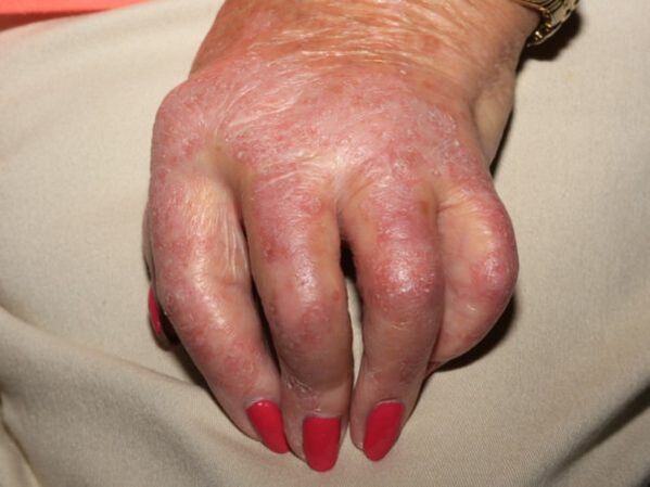 manifestations of psoriasis on the hands