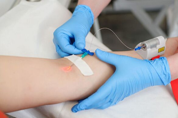 intravenous laser treatment for psoriasis of the feet
