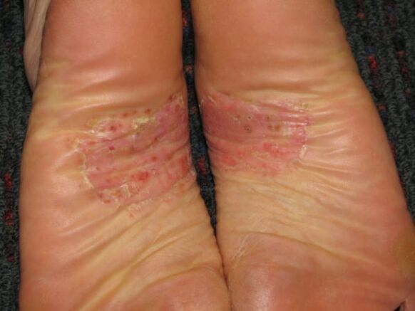 psoriasis of the feet