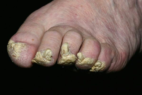 toenail psoriasis