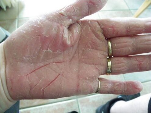 psoriasis on the palms of your hands