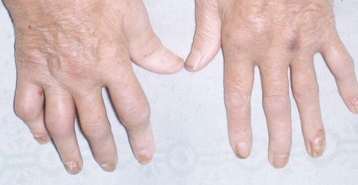 arthropathic psoriasis of the hands