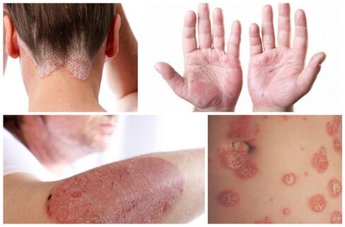 symptoms of psoriasis on the body