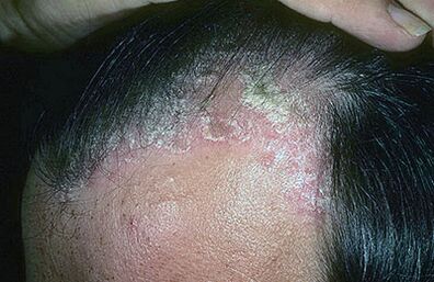 psoriasis on the head photo 1