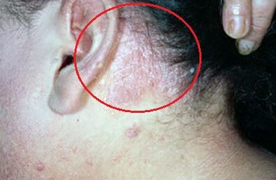 psoriasis on the head picture 2