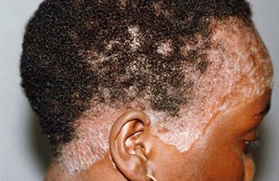 psoriasis on the head picture 3