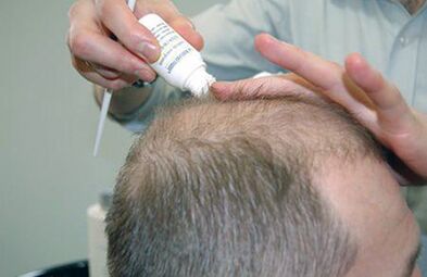 treatment of scalp psoriasis