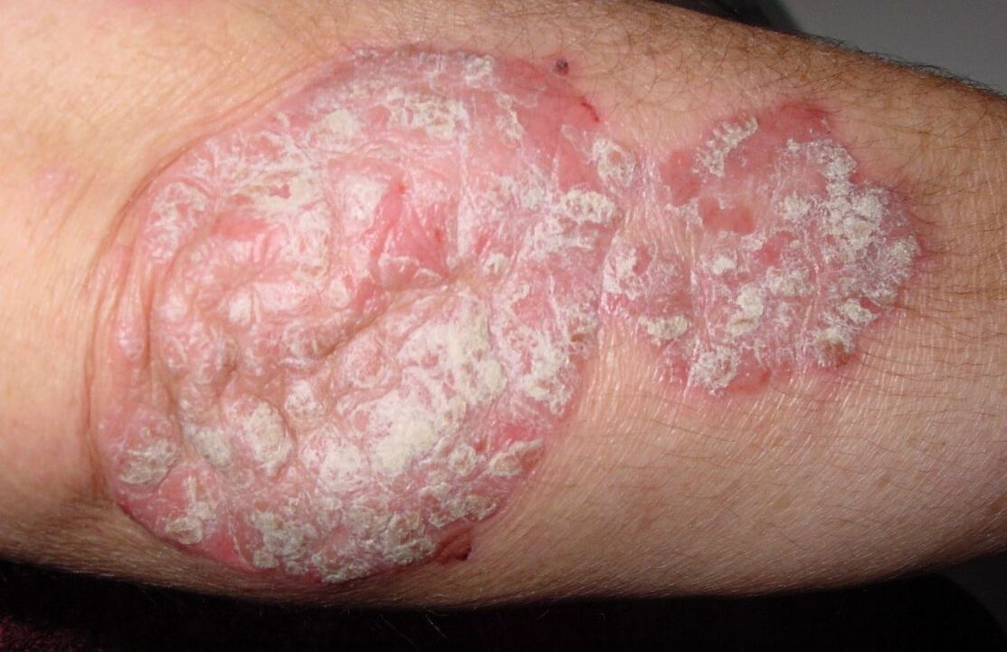 psoriasis of the elbow
