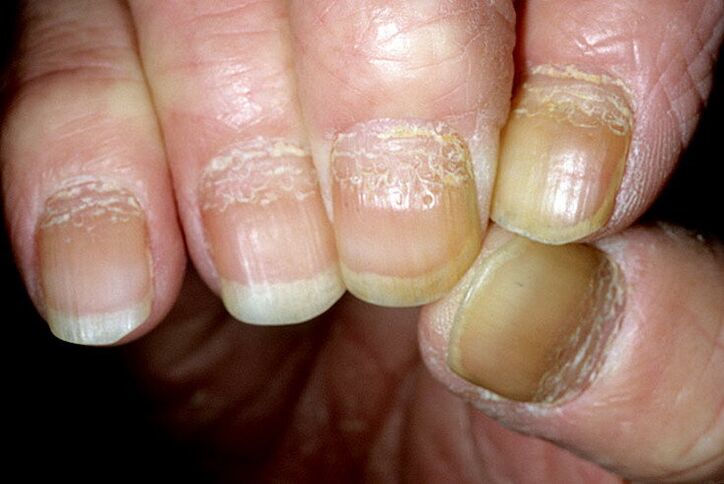 psoriasis on the nails