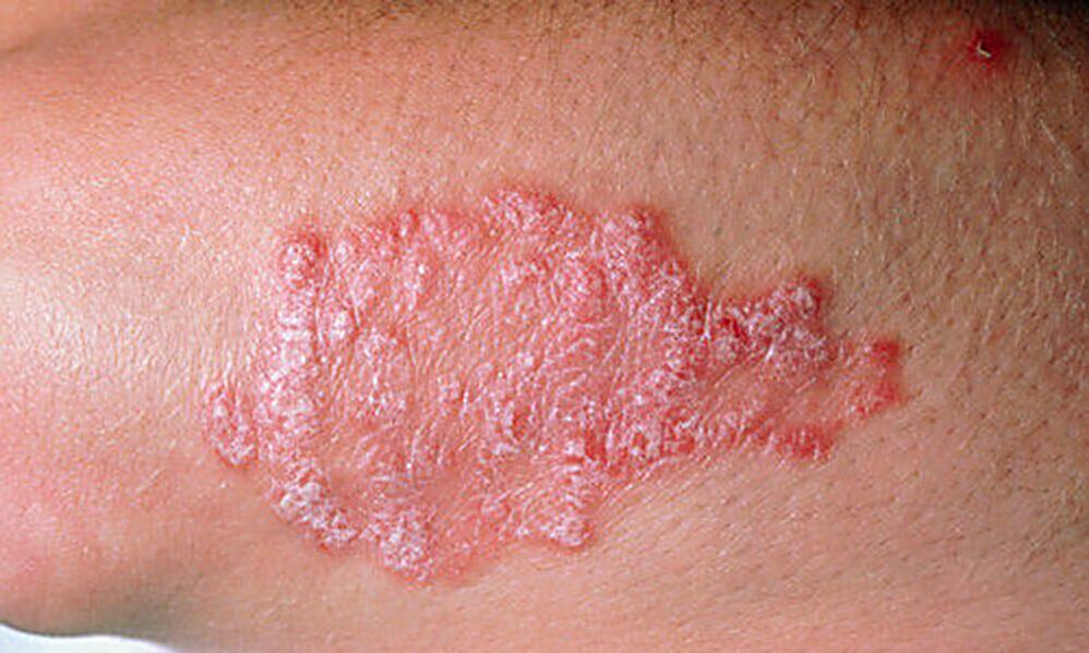 psoriasis plaque