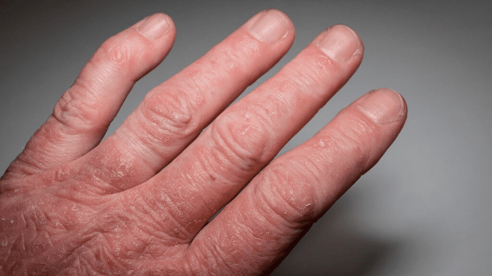 psoriatic arthritis of the hands