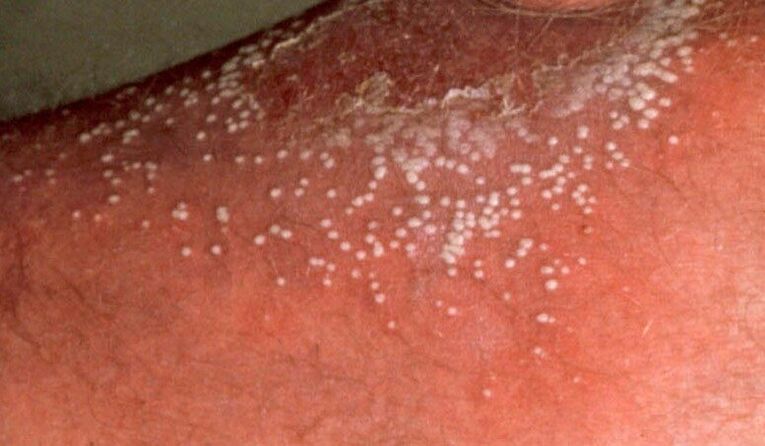 pustular psoriasis