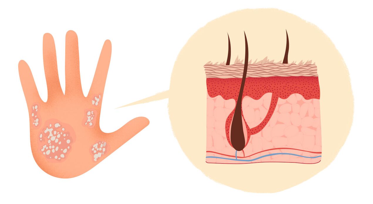 signs of psoriasis on the hands