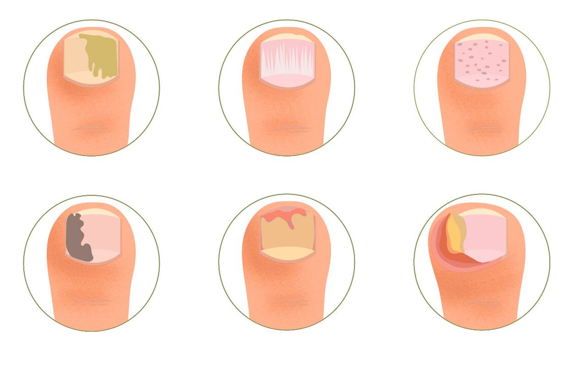 symptoms of psoriasis on the nails