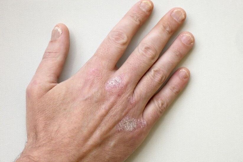 Mandatory symptoms of psoriasis are plaques with scales on the skin
