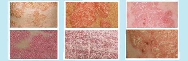 Skin rashes characteristic of various types of psoriasis