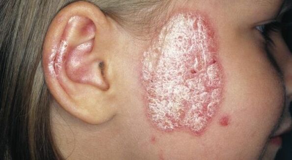 psoriatic plaques on the face