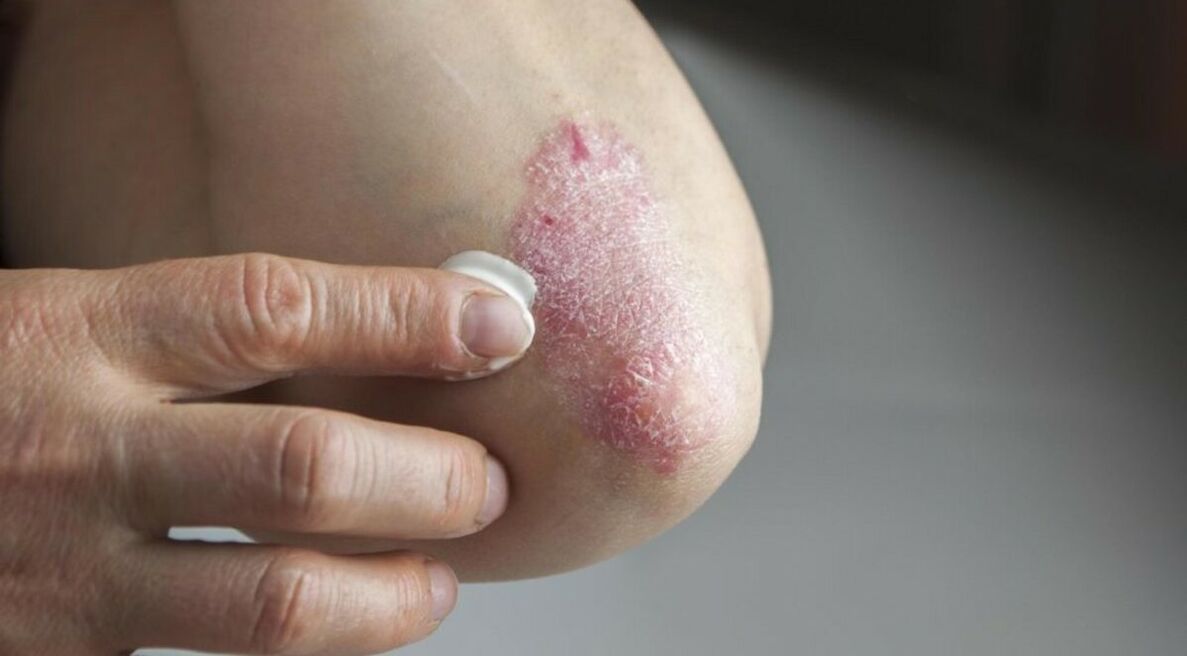 Psoriasis affecting the skin, treatment of which includes the use of ointments