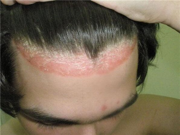 Manifestations of psoriasis on the scalp