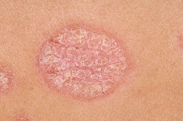 psoriasis on the body