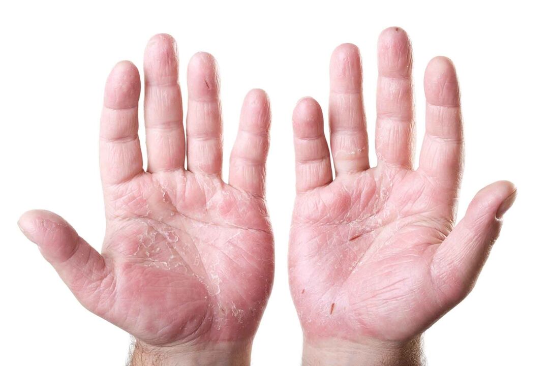type of psoriasis on the palms