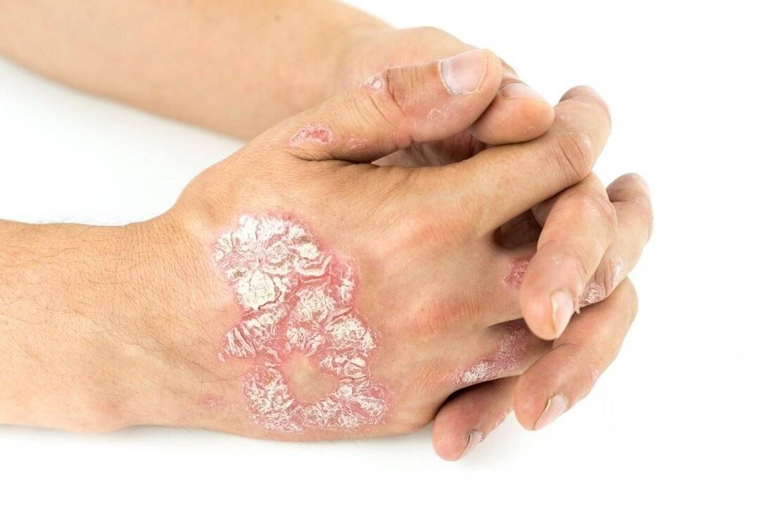 worsening of psoriasis on the hands
