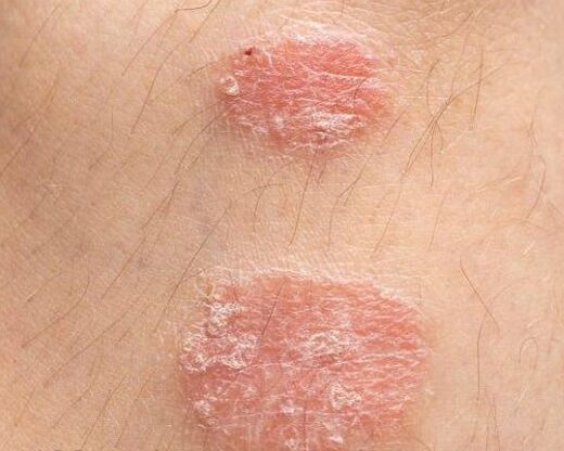 Psoriatic plaque appearance