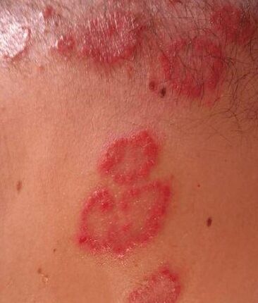 The place of psoriasis