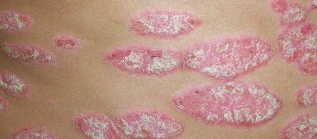 A progressive psoriasis level