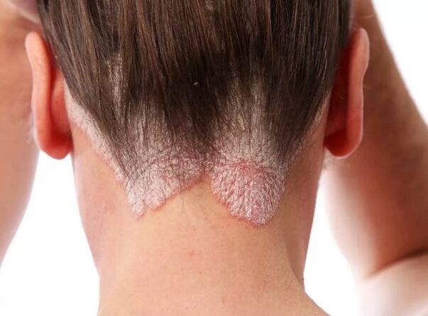 Erythroderma psoriatic