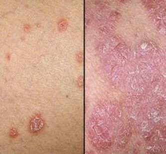 Psoriatic plaque