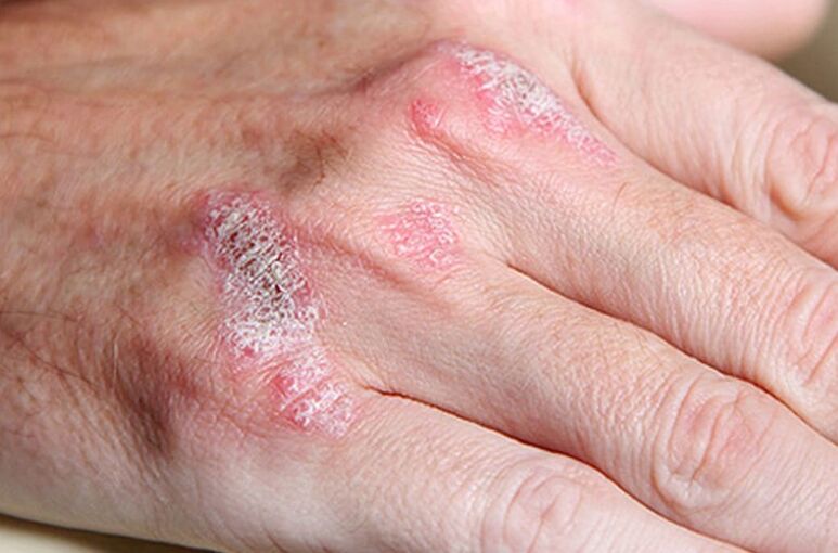 Psoriasis Ladomary is ongoing