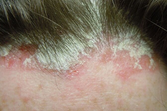 Psoriasis catches the entire hairy part of the head
