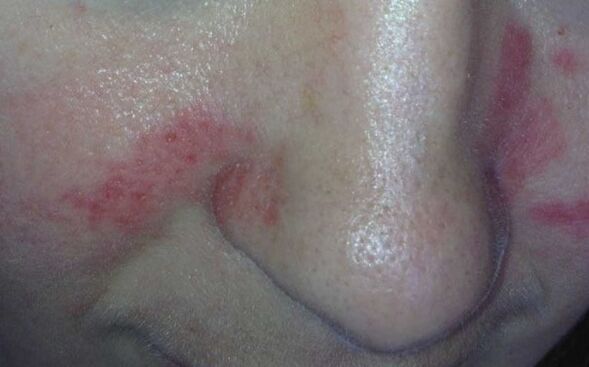 Symptoms of psoriasis in the face