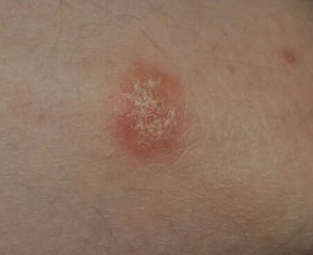 The place of psoriasis