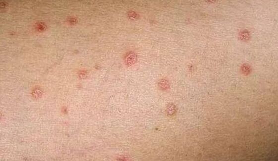 The early stages of psoriasis