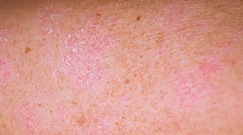 Regressive psoriasis level