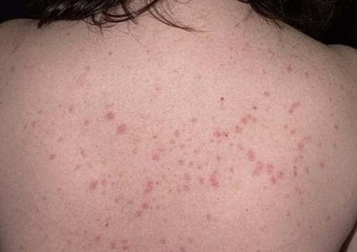 The early stages of psoriasis