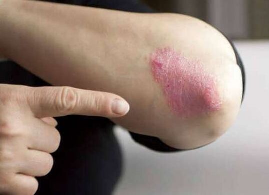 The psoriasis level of stationary