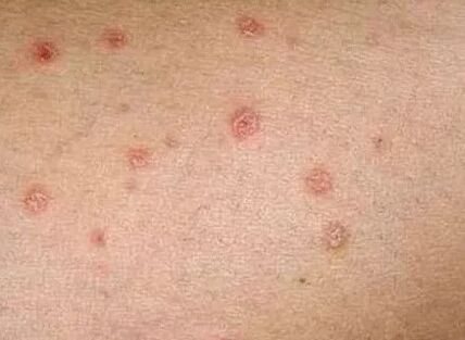 Early stage psoriasis