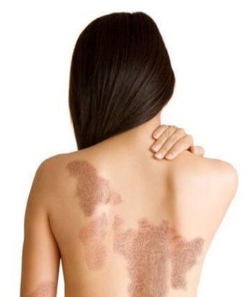 The level of psoriasis depends on the wound area