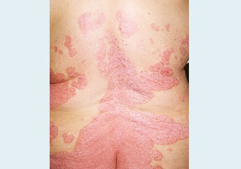 Back psoriasis