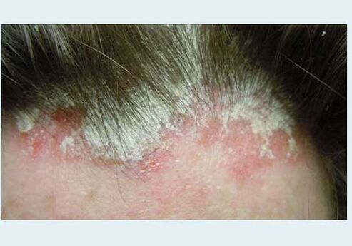 Damage to the head
