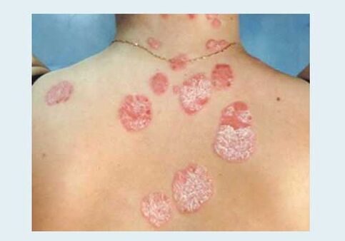Normal psoriasis