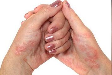Psoriasis in hand