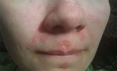 Psoriasis in the face