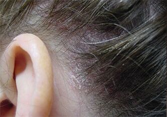 Psoriasis in the head