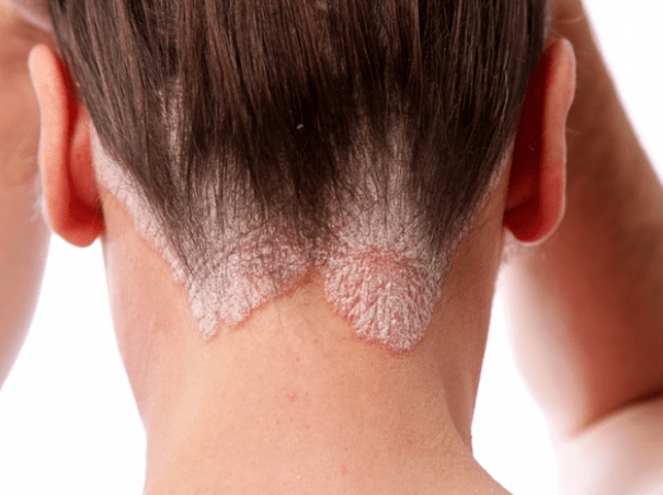 Psoriasis on the head